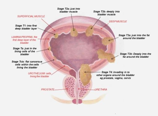 Are all bladder tumor diagnoses cancerous?